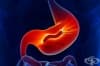     (Helicobacter pylori)