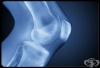 Рентгеново изследване (рентгенография) на коляно