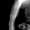 Рентгеново изследване на гръдната кост
