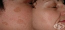 Домашни средства за премахване на кафяви петна по лицето и тялото