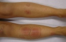 L52 Erythema nodosum