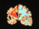 F00*     Alzheimer (G30.-+)