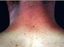 L56.2   [berloque dermatitis]