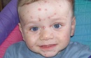 B01 ������� [varicella]