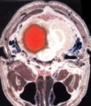 Тромболиза за лечение на мозъчен инсулт вече се прилага в плевенската болница