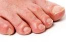 За лечение на гъбички 10 дни мажете ноктите на краката с йод