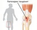 Пателарен тендинит (коляно на скачач)