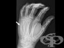 Счупвания в областта на китката, дланта и пръстите при спортисти
