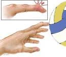 Навяхване и изкълчване на пръстите на ръката при спорт