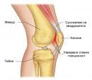Болка в капачката на коляното при спортисти (коляно на бегач)