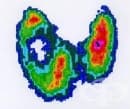 Радиоизотопно изследване на щитовидната жлеза