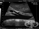 Ултразвуково изследване (ехография) на аортата
