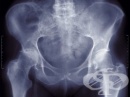 Рентгеново изследване на илиачната кост