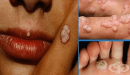 ���������� �� ������� �������� ����� - human papillomavirus (HPV)