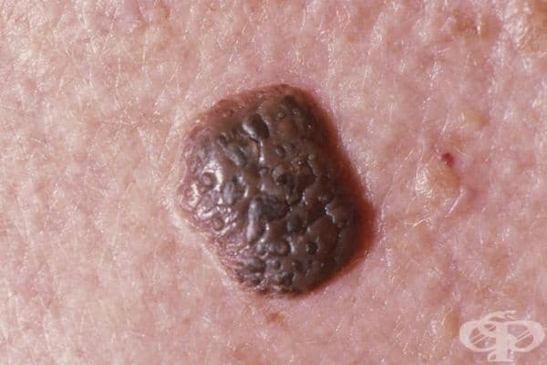 Себорейна кератоза. Кожно заболяване, характеризиращо се с появата на доброкачествени тумороподобни новообразувания по кожата. Себорейните кератоми растат бавно и имат различни размери. Появяват се при хората над 50г.