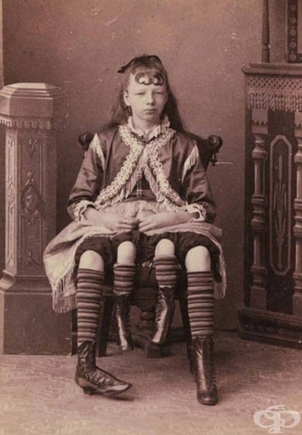 Жозефина Корбин - жената с четири крака и две вагини. Актрисата е дала живот на 5 деца и имала щастлив семеен живот.