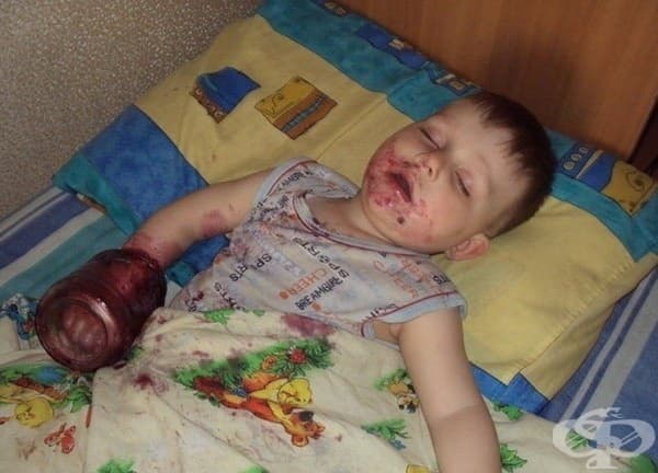 Предозиране със захар.