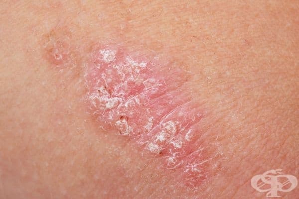 Псориазис. Това е често срещано автоимунно състояние, при което организмът произвежда кожни клетки с бързи темпове, причинявайки им натрупване на повърхността. Това може да доведе до червени петна или повдигнати неравности по кожата.