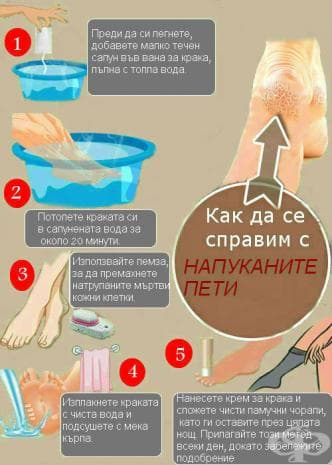 Лесен начин за лечение на напукани пети