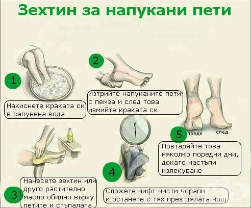 Как да прилагаме зехтин при напукани пети