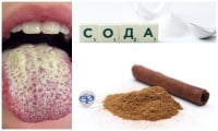 Домашно лечение на гъбички в устата