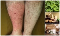 Народна медицина за лечение на червен вятър