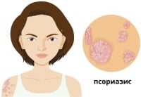 Как да разпознаем псориазиса