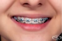 Брекетите могат да бъдат опасни за зъбите и венците на детето