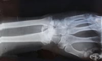 Физическите упражнения ускоряват зарастването на счупена кост