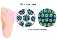Кокоши трън – причини за поява и лечение