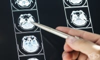Ранното отстраняване на яйчниците е свързано с намалено бяло мозъчно вещество