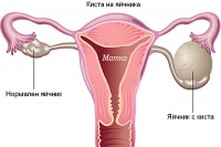 Хранене при киста