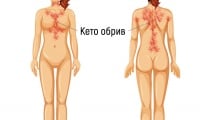 Кето обрив