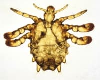 B85.3 Фтириоза