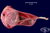 O69.4   ,      [vasa praevia]