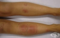 L52 Erythema nodosum