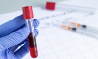 B74.2 Филариоза, предизвикана от Brugia timori