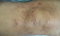 C84.0 Mycosis fungoides