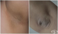L83 Acanthosis nigricans