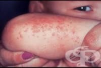 L44.4      [Gianotti-Crosti]