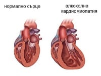 I42.6 Алкохолна кардиомиопатия