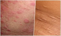 L90.2 ����������� �� Jadassohn-Pellizzari