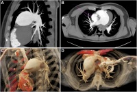 I28.1 ��������� �� ���������� �������