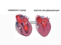 I35.1 Аортна (клапна) инсуфициенция