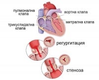 I35.2 Аортна (клапна) стеноза и инсуфициенция