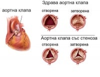 I35.0 Аортна (клапна) стеноза