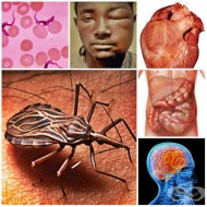B57 Болест на Chagas