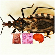 B57.5   Chagas ()     