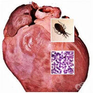 B57.2   Chagas ()     (I41.2*, I98.1*)