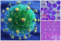 B21.1 Болест, предизвикана от HIV, с прояви на Burkitt-лимфом